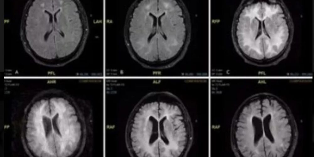 Demuestran cómo la cocaína consume el cerebro en pocos meses